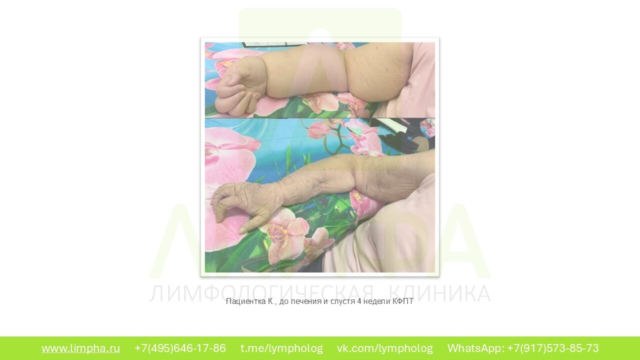 До лечения — Лимфостаз после операции