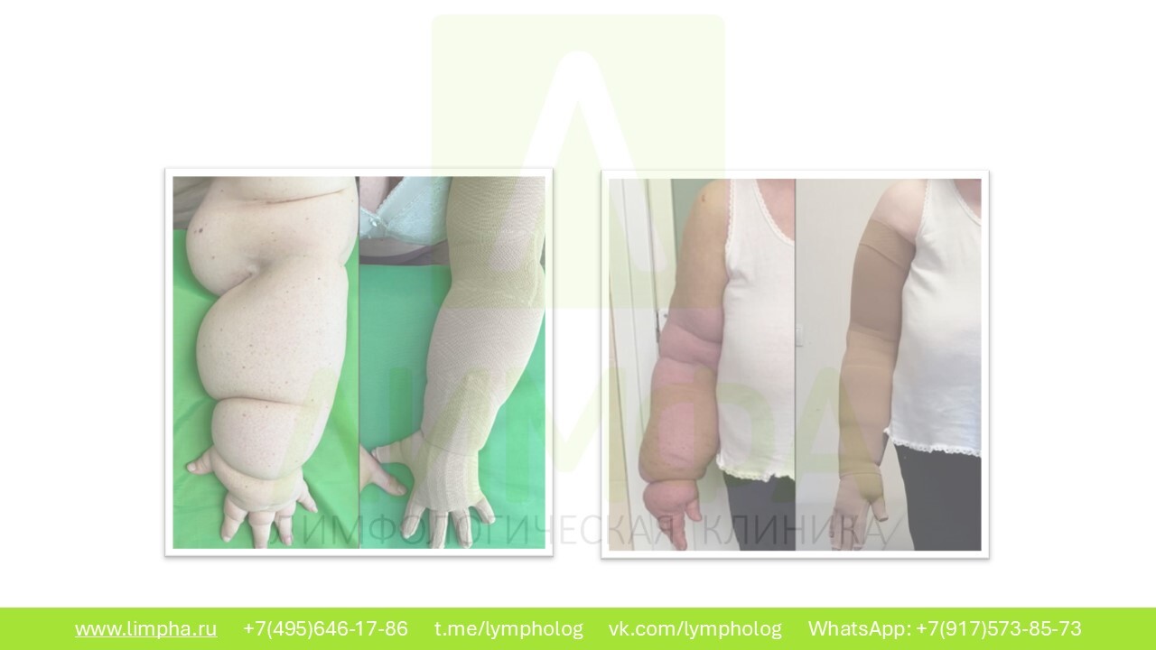 До лечения — Вторичный лимфостаз