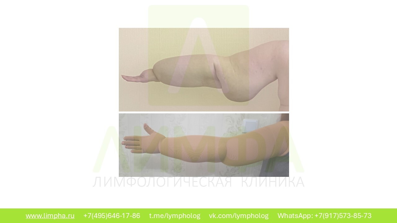 После лечения — Лимфедема II степени