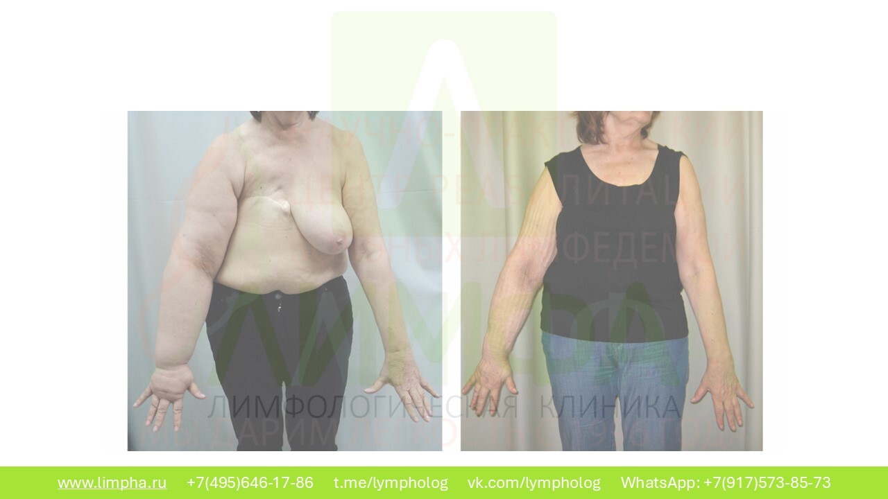 После лечения