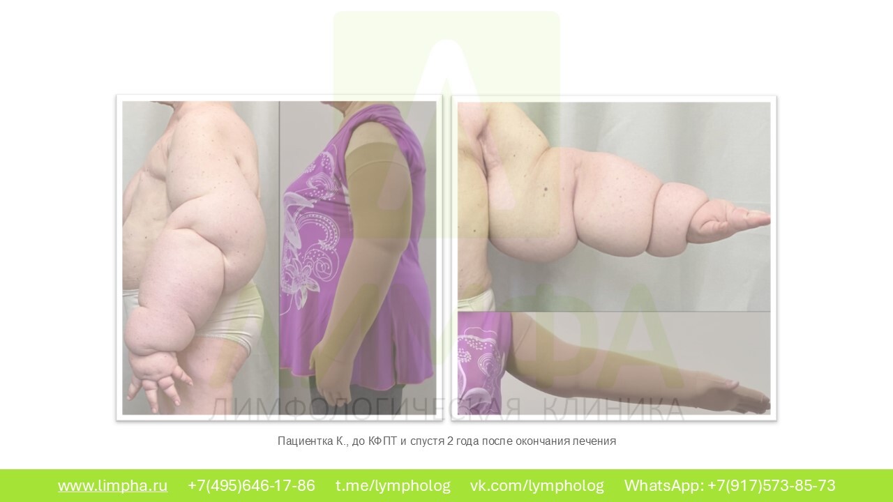 После лечения — Слоновость нижних конечностей