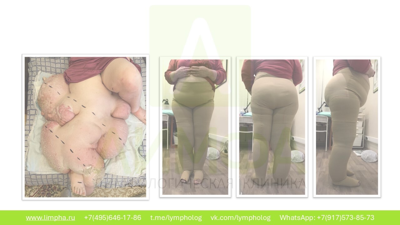 После лечения — Вторичный лимфостаз