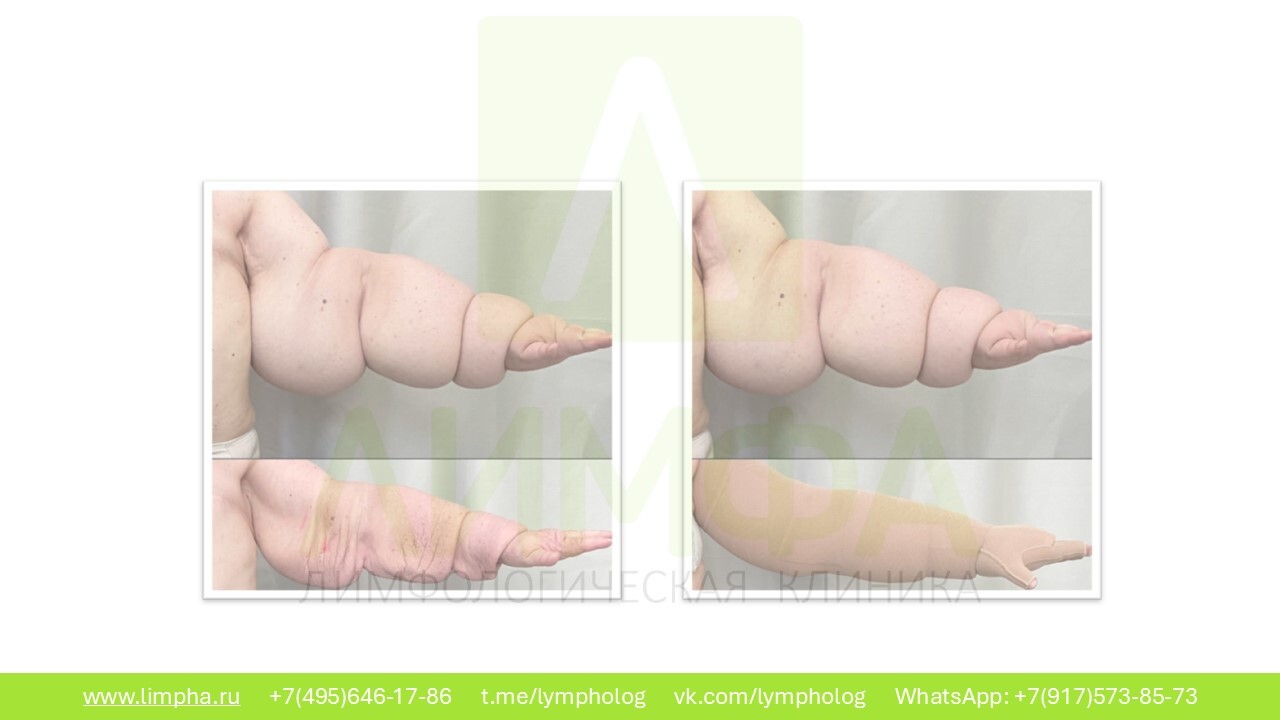 До лечения — Лимфедема II степени